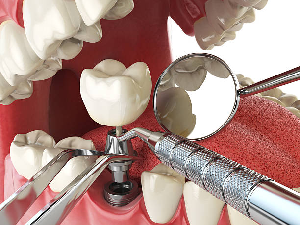 Best Emergency Wisdom Teeth Removal in Queensland, MD