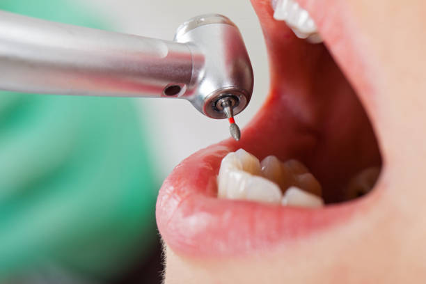 Best Emergency Gum Treatment in Queensland, MD